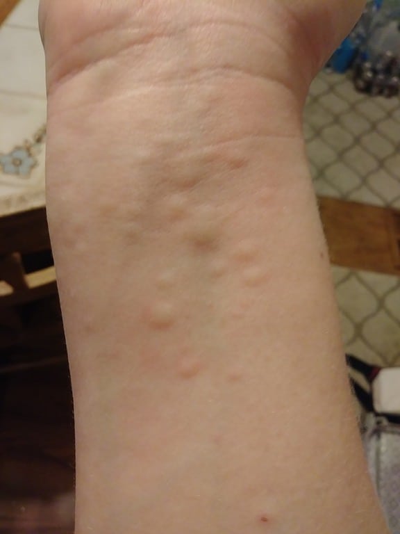 Wrist with raised skin color bumps and redness around them.