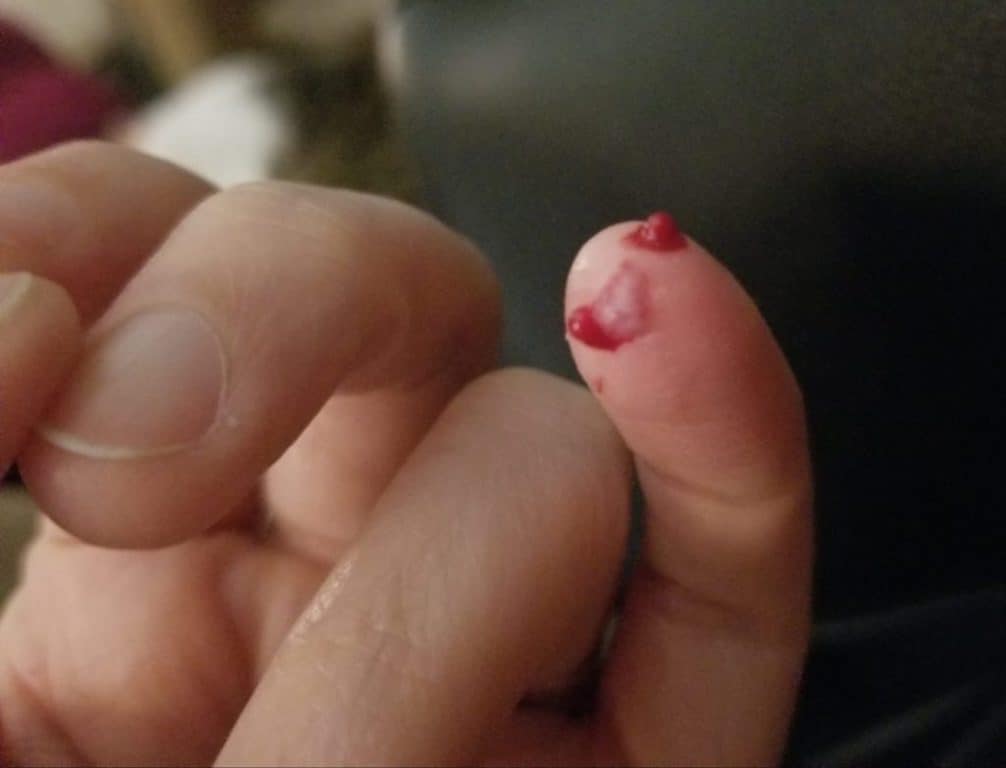 bloody finger tip from a hedgehog bite